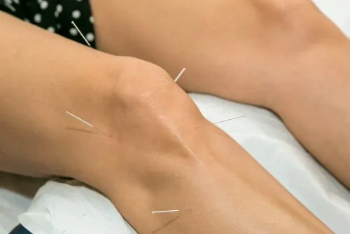 Acupuncture for knee pain Hervey Bay