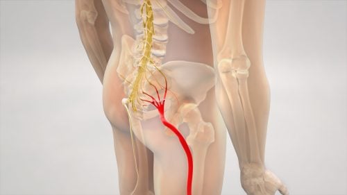 Sciatica Treatment Hervey Bay
